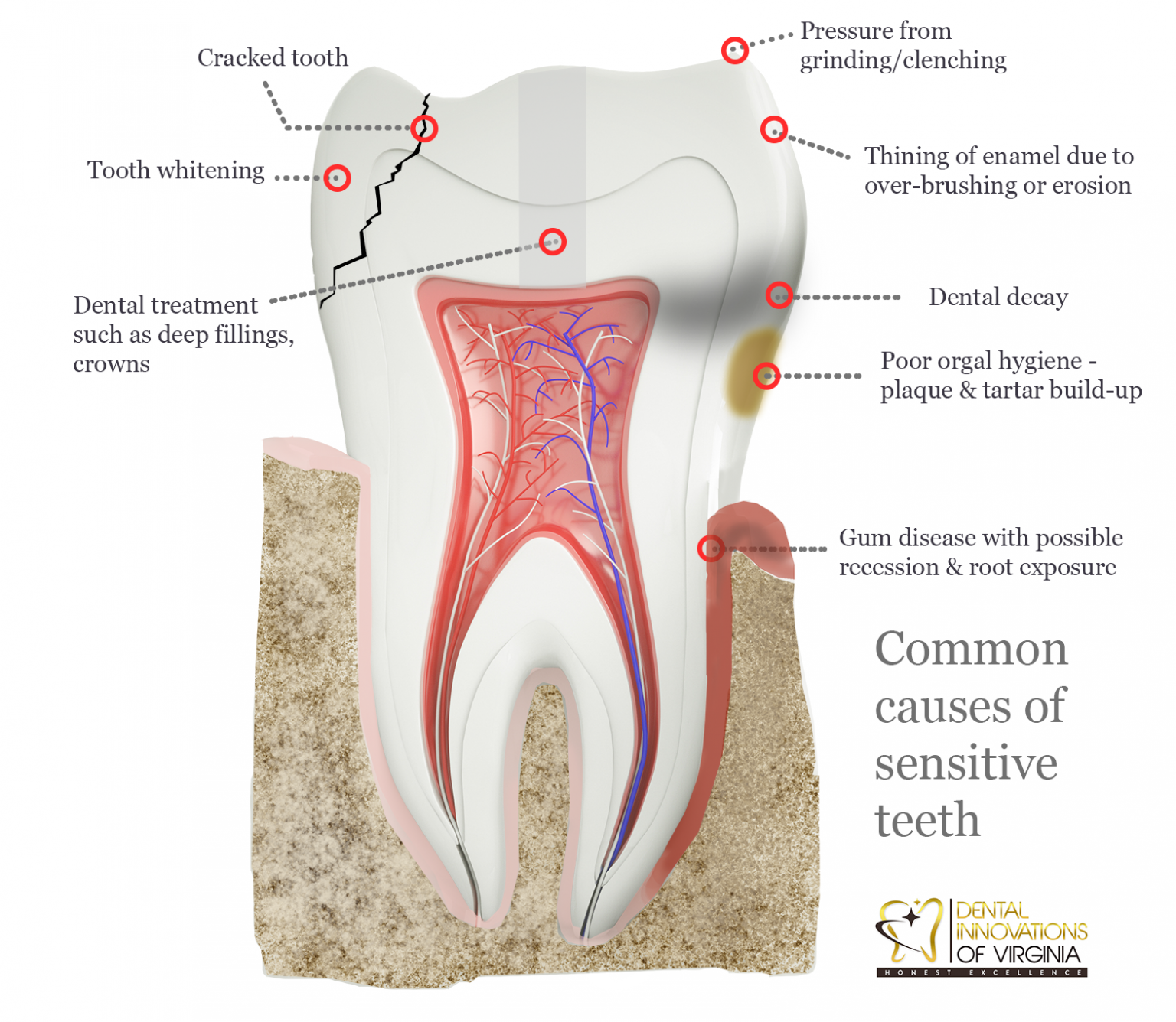 Sensitive Teeth or Sensitive Gum? Lansdowne, VA Family Dentistry