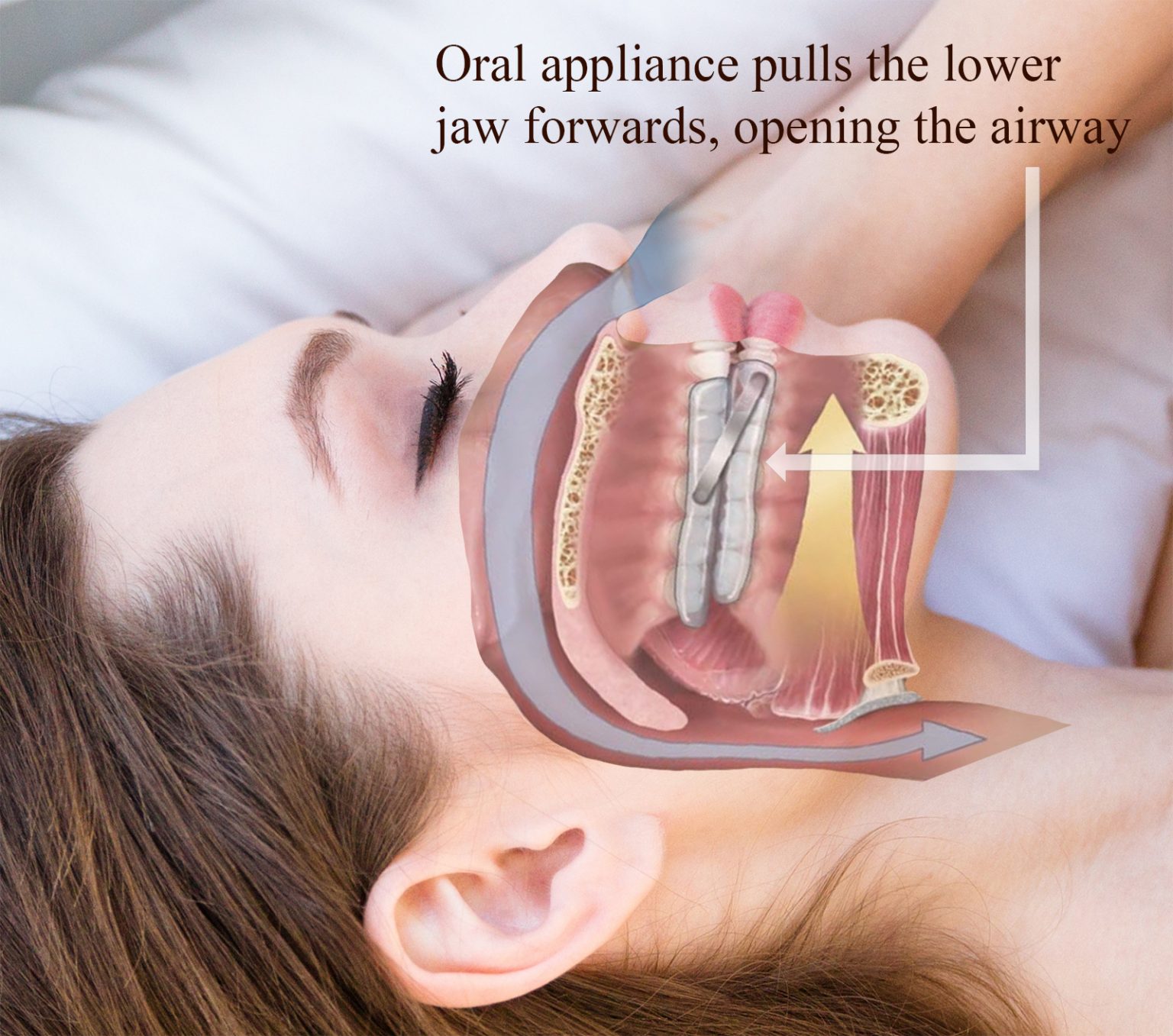 Oral Appliance for Obstructive Sleep Apnea Lansdowne, VA Family Dentistry