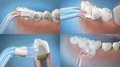 Lansdowne dentist: More tips for using water flossers