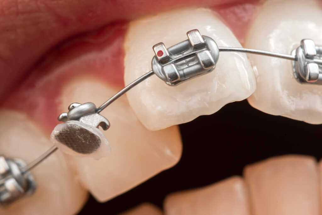 Types Of Dental Braces Lansdowne VA Family Dentistry