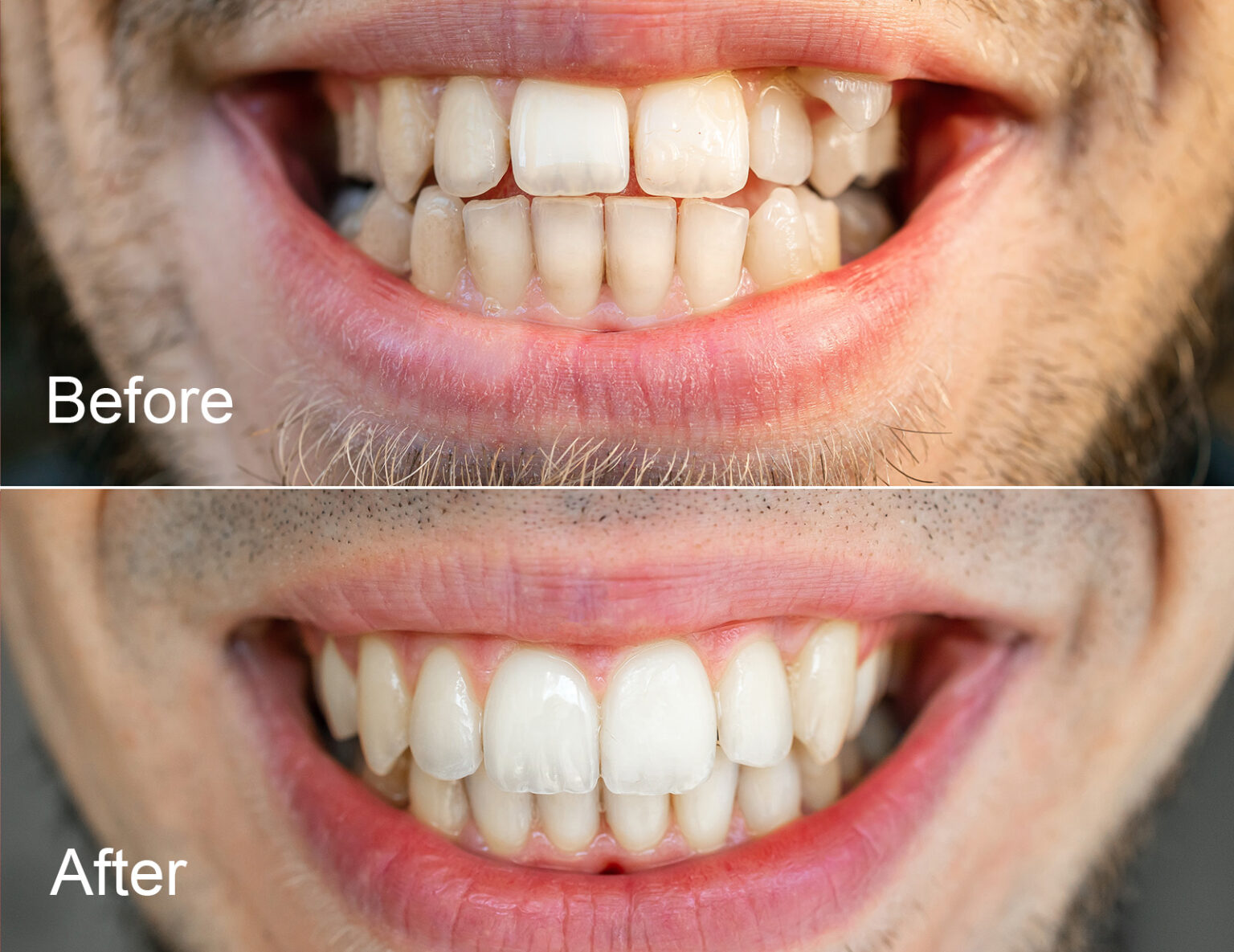 Clear Aligners (Invisalign) Lansdowne, VA Family Dentistry