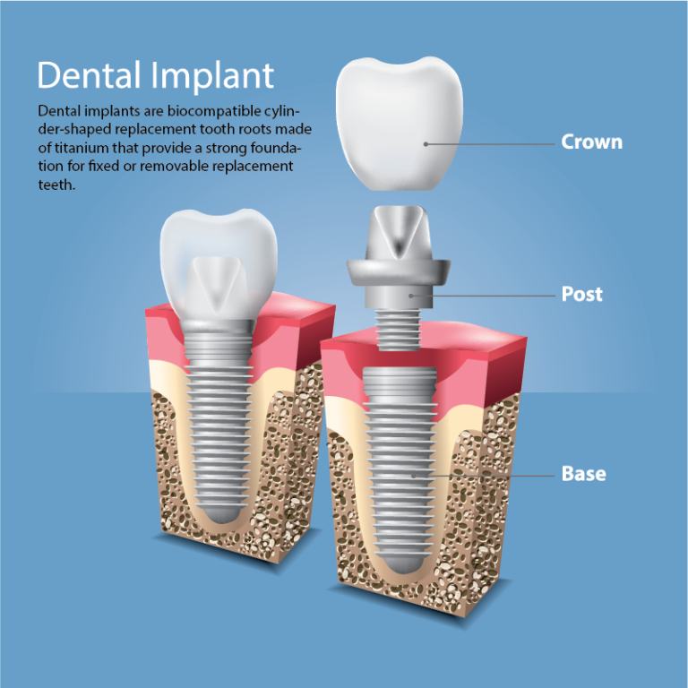 Dental Implant - Your family Ashburn, Lansdowne, Leesburg VA dentist 
